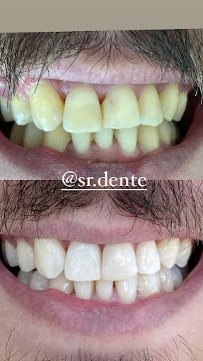 Clareamento Dental